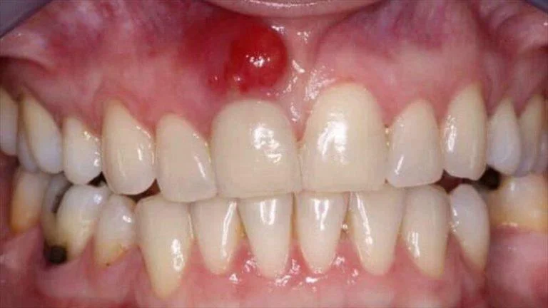 Tooth Infection Dental Abscess Sydney – Emergency Care at Paynless Dental